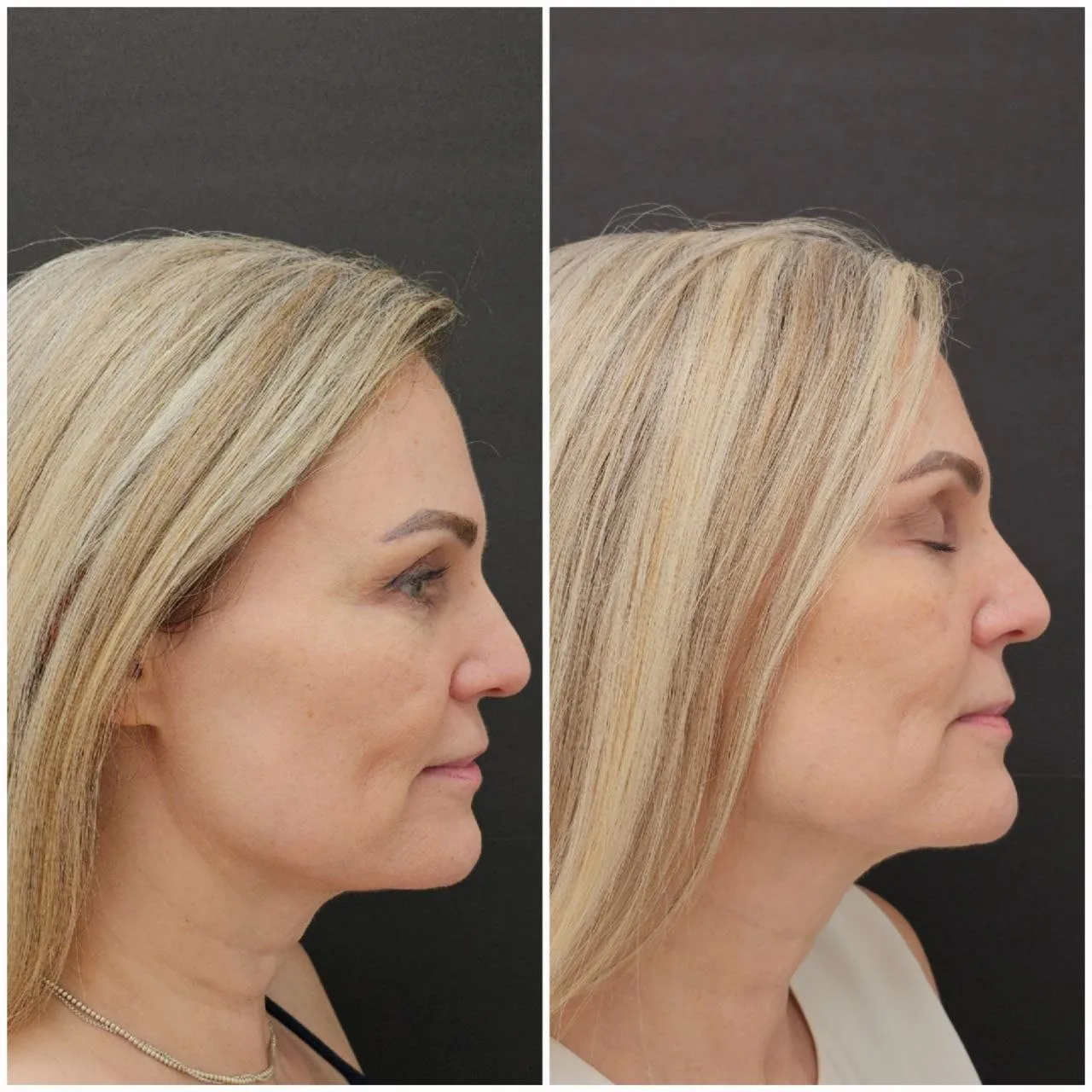 Nefertiti Neck Lift before and after: a Dermarich patient photographed in profile, before on the left and after on the right.