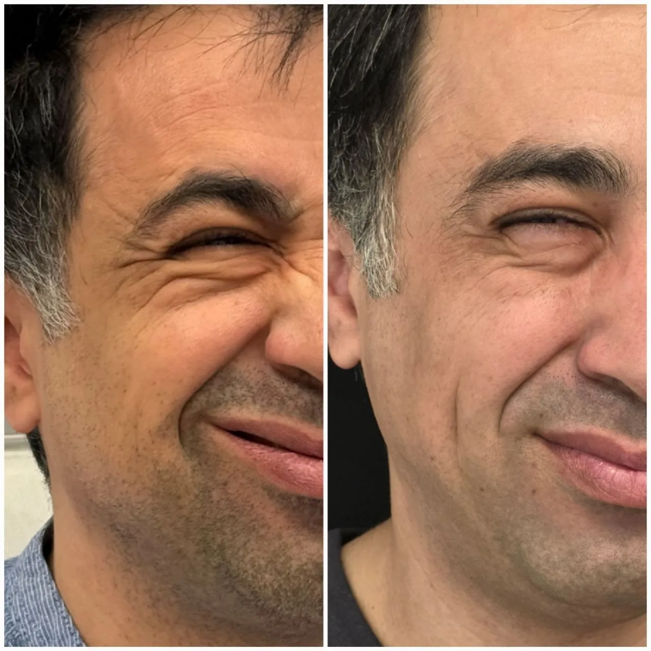 Botox before and after comparison of a Dermarich patient: the before photo is on the left and the after photo is on the right.