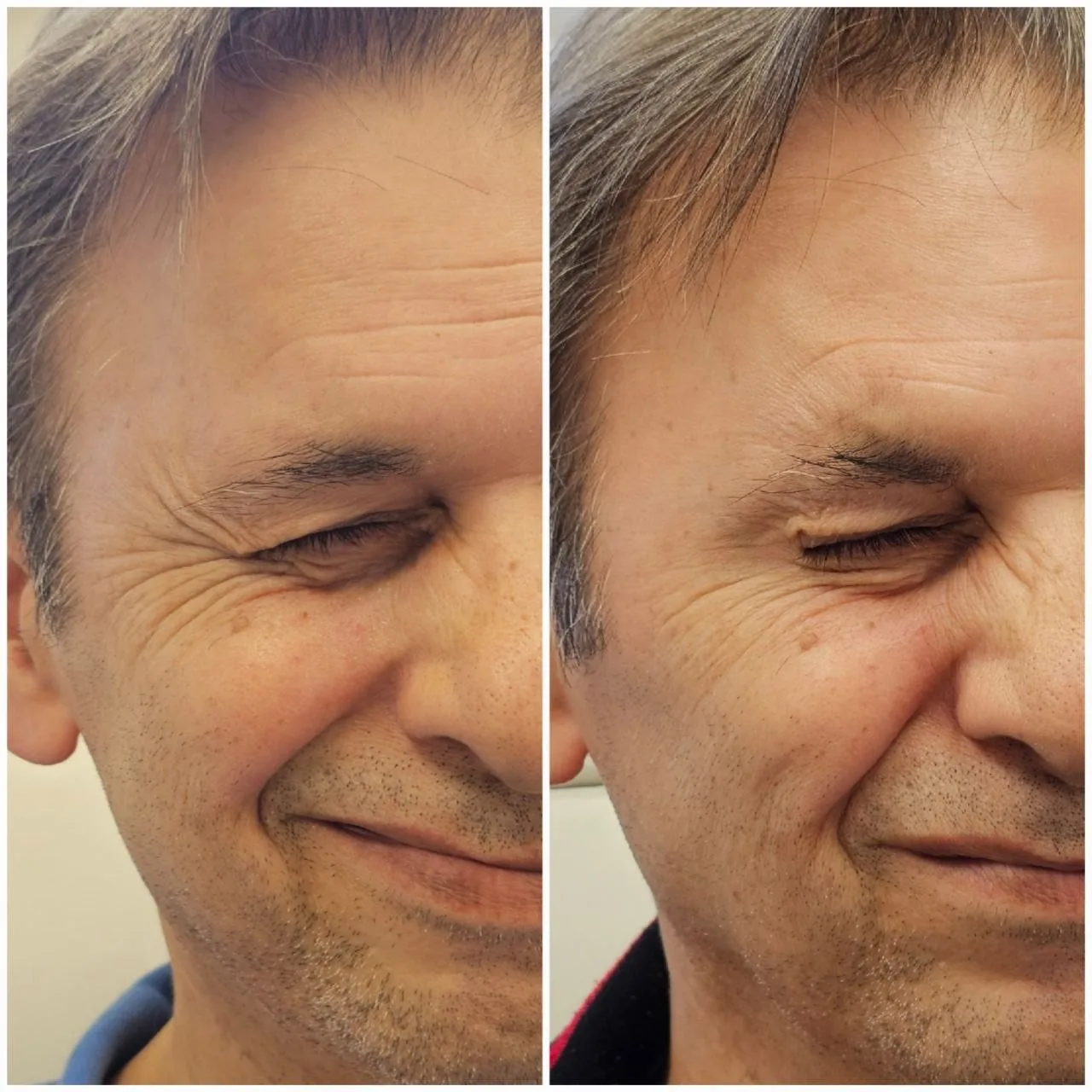 Botox before and after comparison of a Dermarich patient: the before photo is on the left and the after photo is on the right.