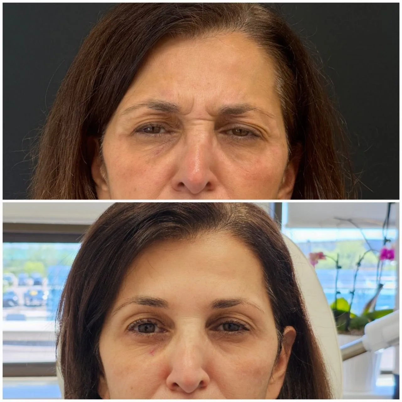 Botox before and after comparison of a Dermarich patient: the before photo is on top and the after photo is below.