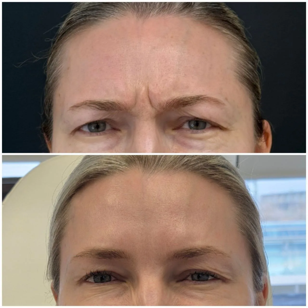 Botox before and after comparison of a Dermarich patient: the before photo is on top and the after photo is below.